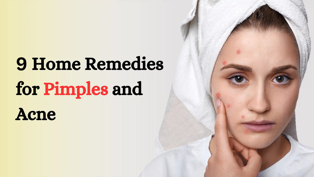 9 Home Remedies for Pimples and Acne